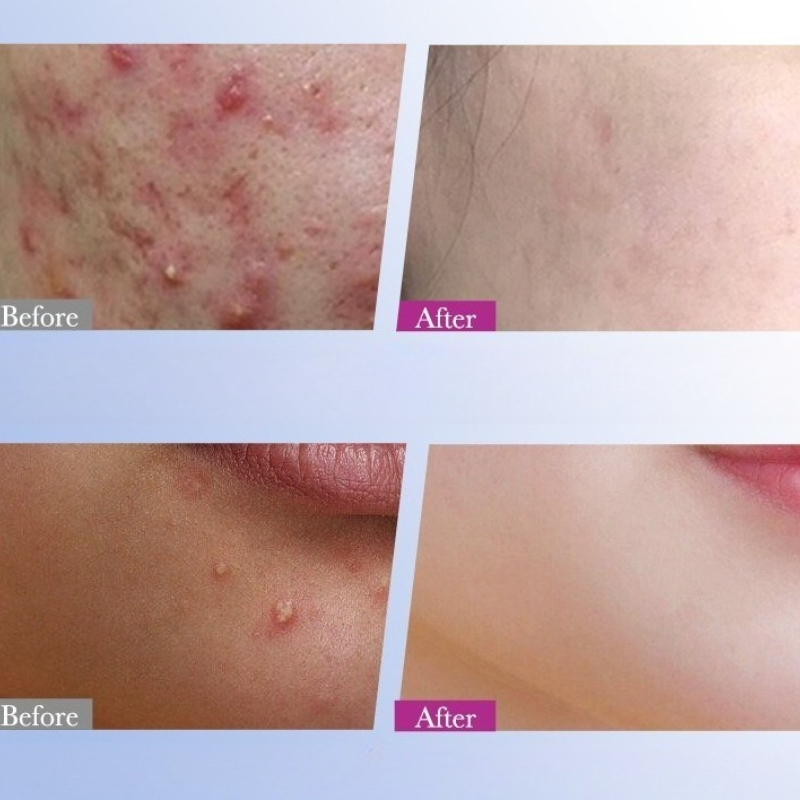 7/10/14 قطعة الملونة ستار حب ا - مراجعة Skincare Qv وسعره